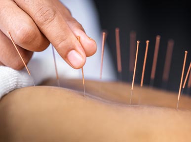 Acupuncture