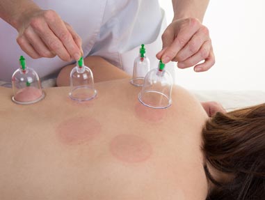 Cupping